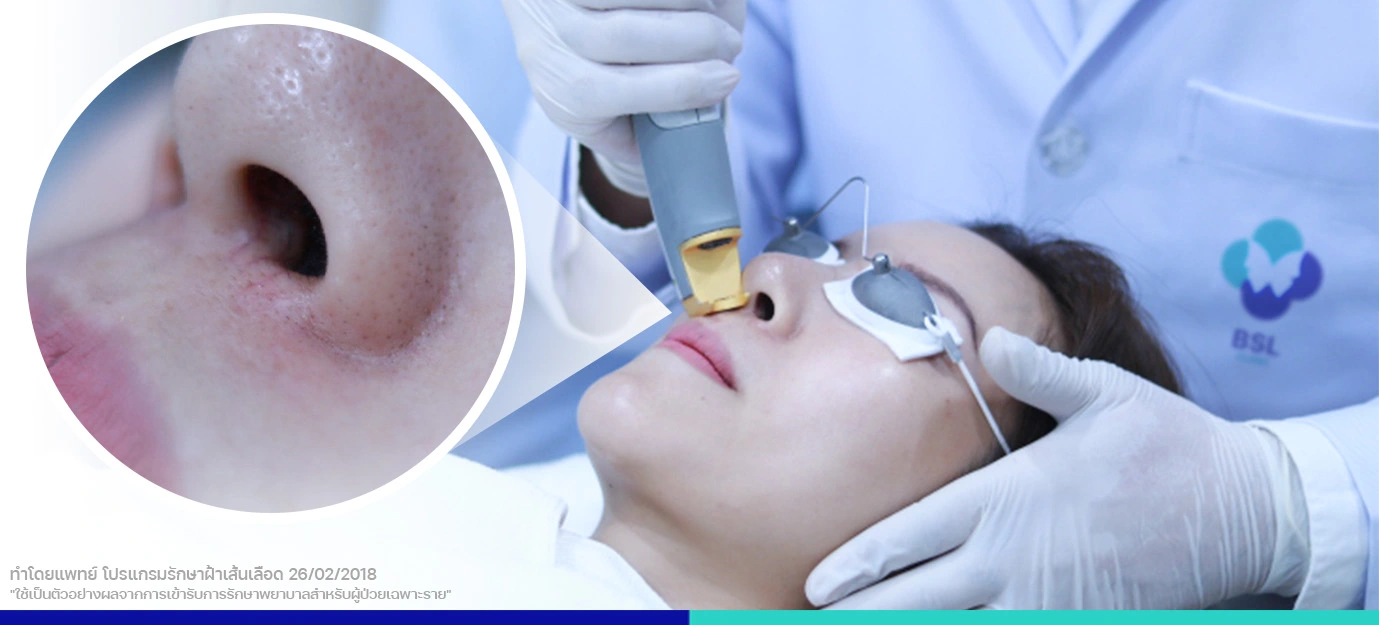 รักษาฝ้าเส้นเลือด