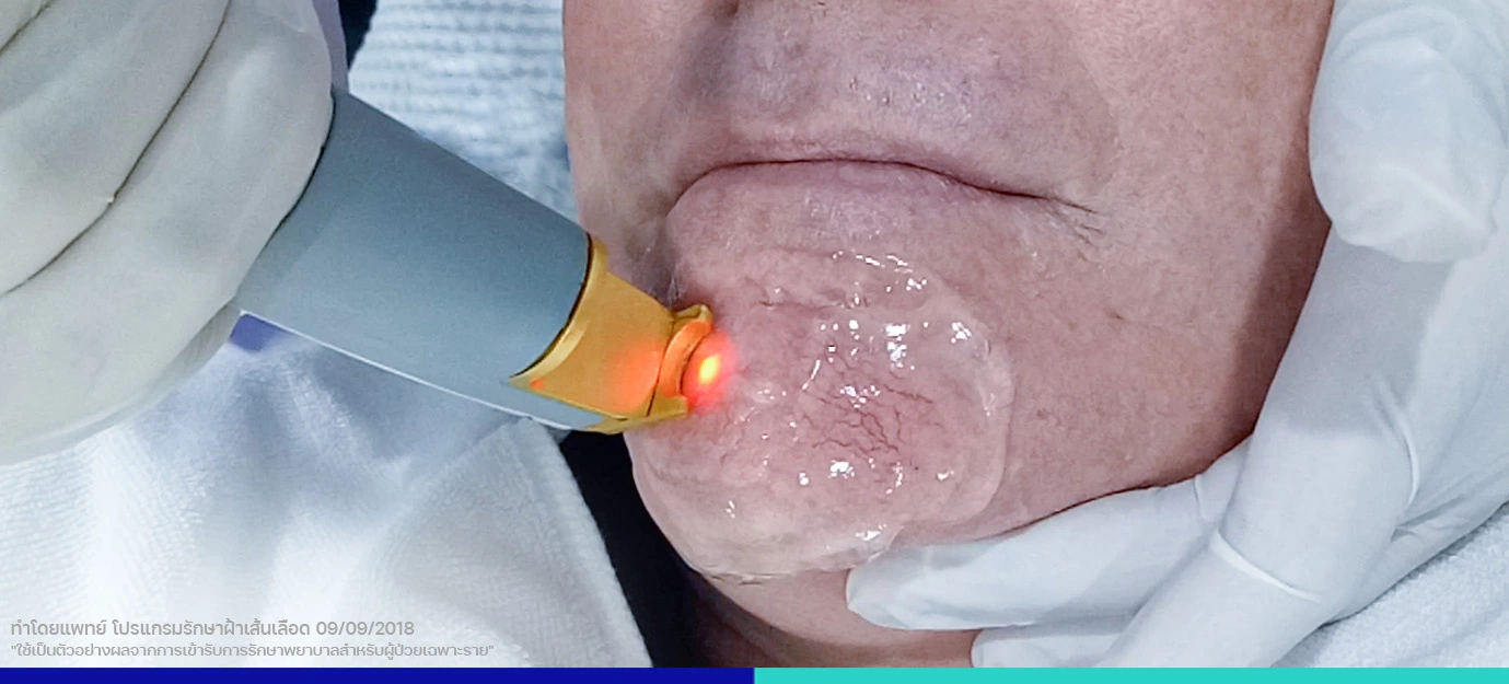 เส้นเลือดฝอย