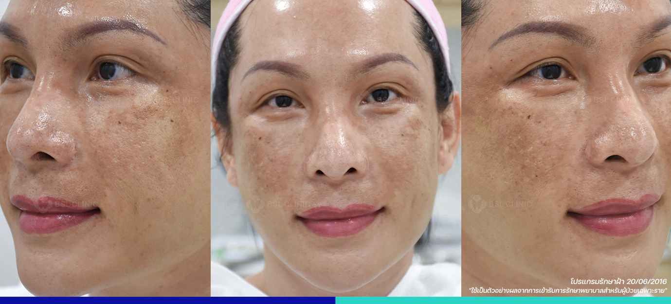 รีวิวก่อนรักษาฝ้า