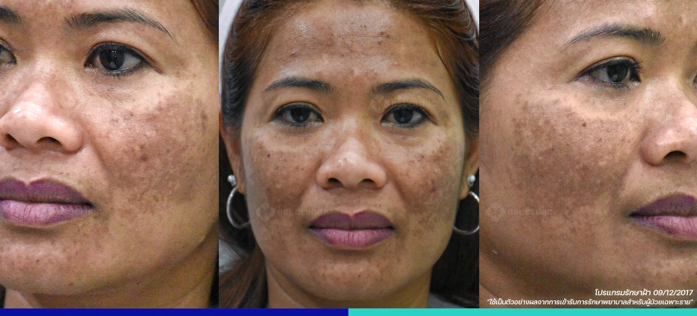 รีวิวก่อนรักษาฝ้า