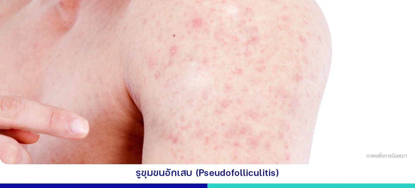 รูขุมขนอักเสบ(Pseudofolliculitis)