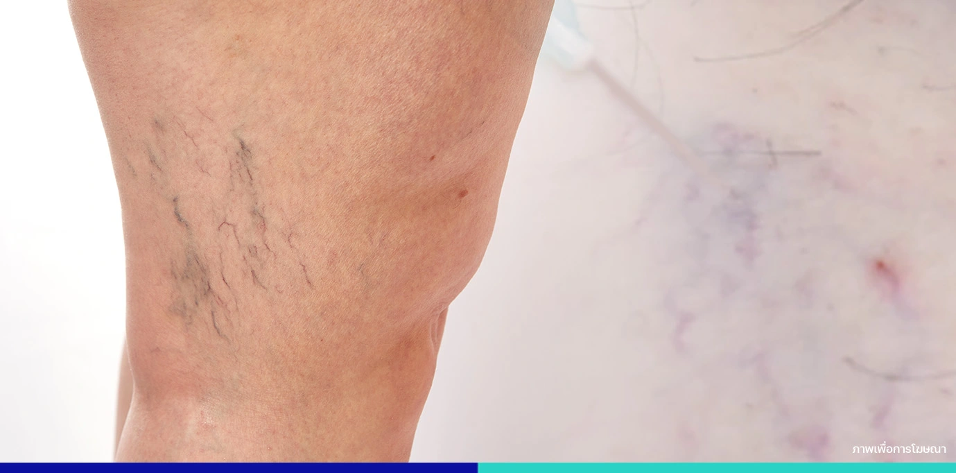 ลักษณะของเส้นเลือดขอด