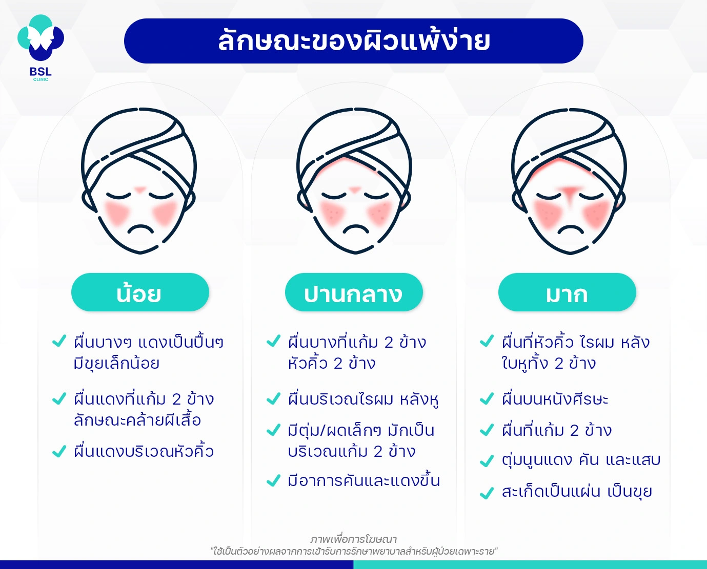 รักษาผิวแพ้ง่าย
