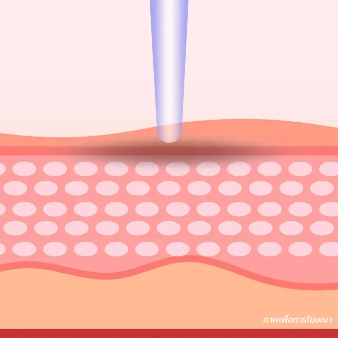 วิธีรักษาฝ้า เลเซอร์ลดเม็ดสี