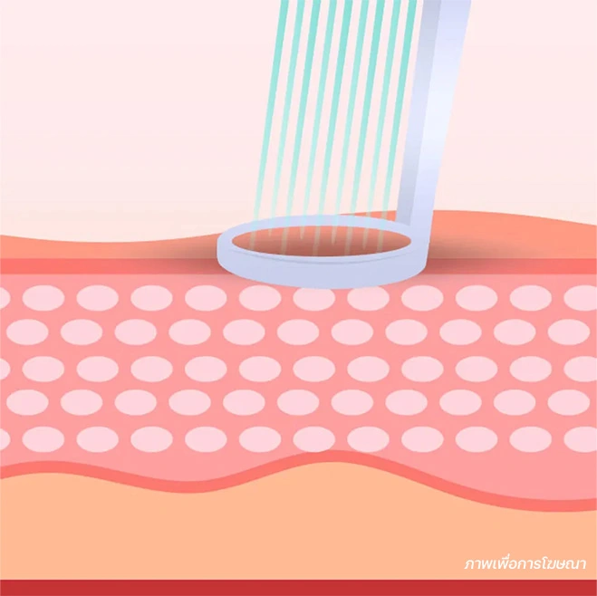 วิธีรักษาฝ้า picoway เลเซอร์ลดเม็ดสี