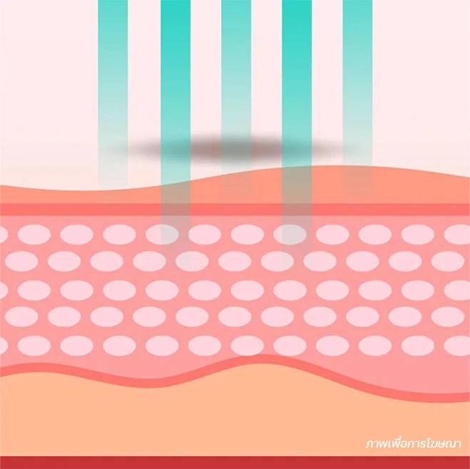 วิธีรักษาฝ้า เลเซอร์ดึงเม็ดสี