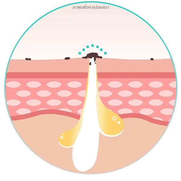 สาเหตุของสิว การอุดตันของรูขุมขน