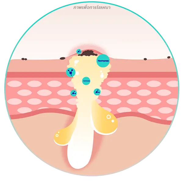 สาเหตุของสิว ฮอร์โมน