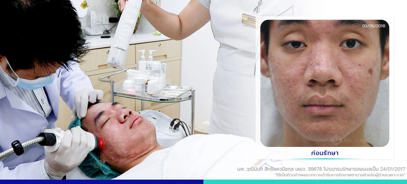 หลุมสิว เลเซอร์แผลเป็นรอยแผลเป็นจากสิว