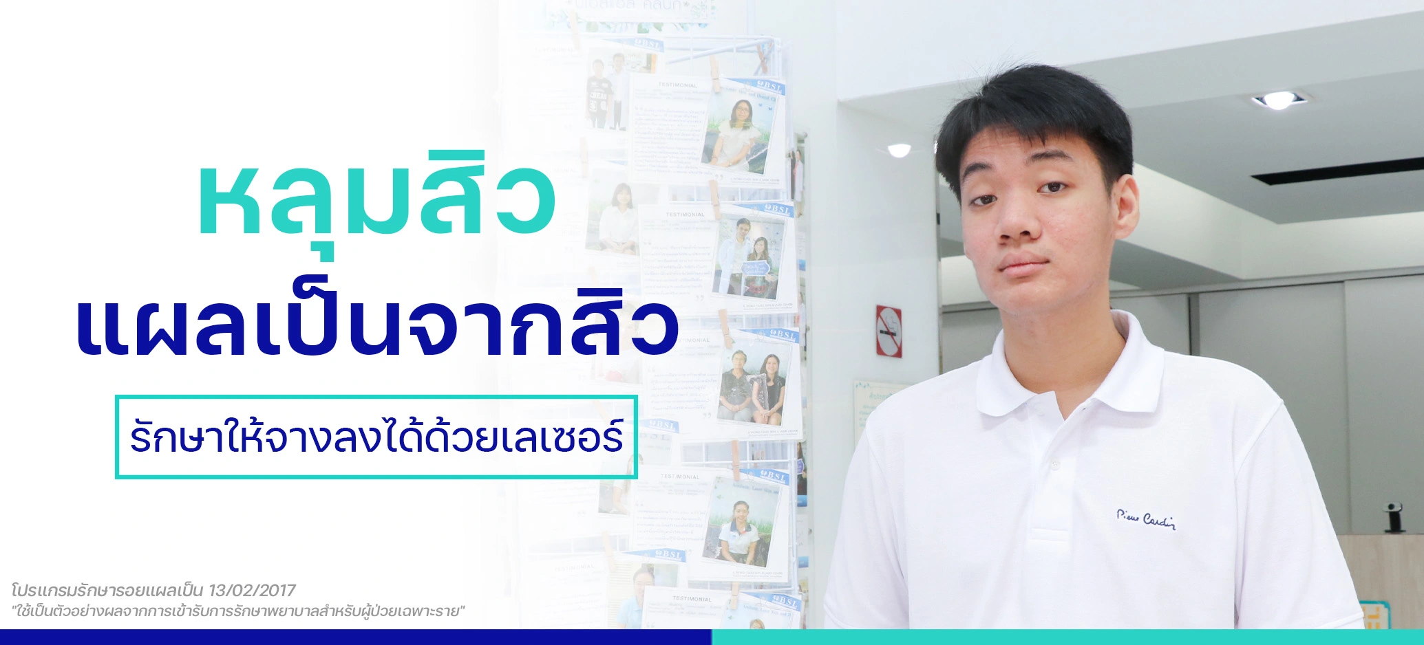 หลุมสิว รอยแผลเป็นจากสิว