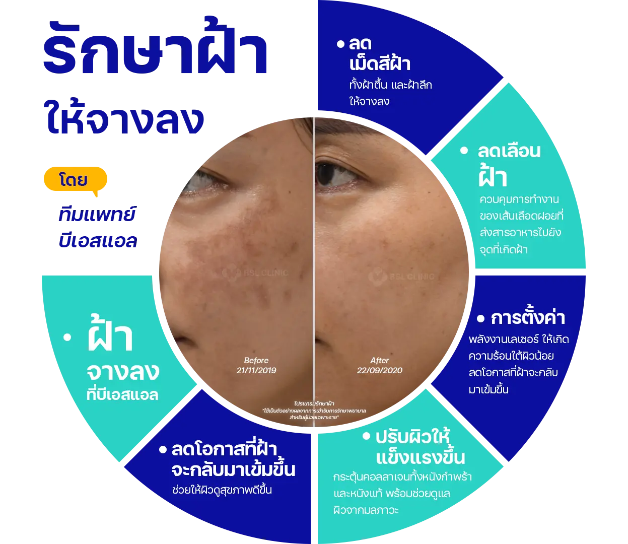 เทคนิครักษาฝ้า BSL Clinic