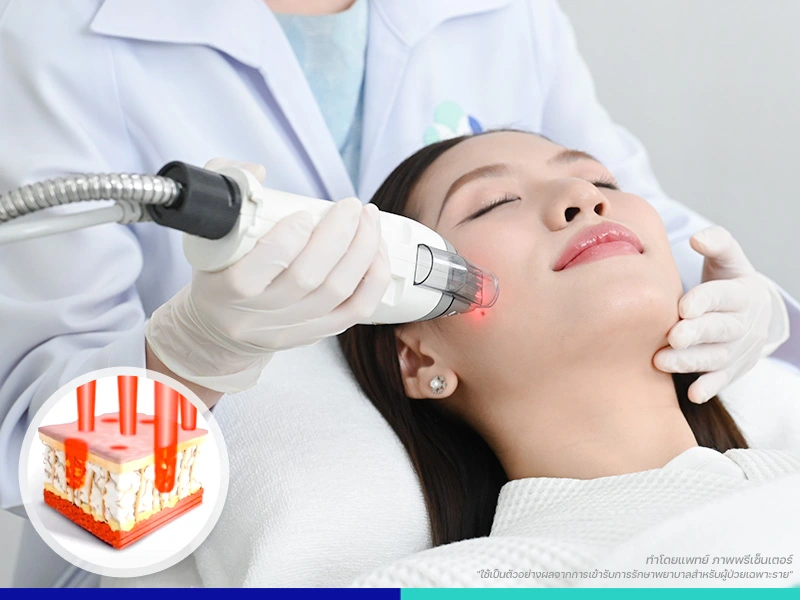 เลเซอร์รักษากระ