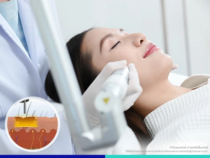 เลเซอร์รักษากระ