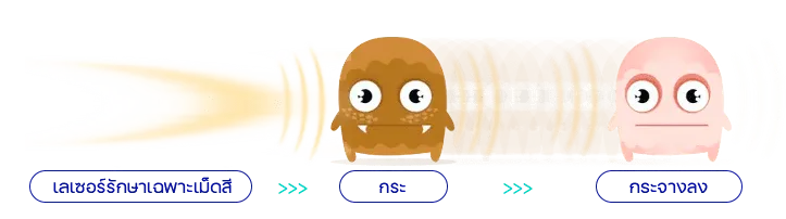 เลเซอร์รักษาเฉพาะเม็ดสี