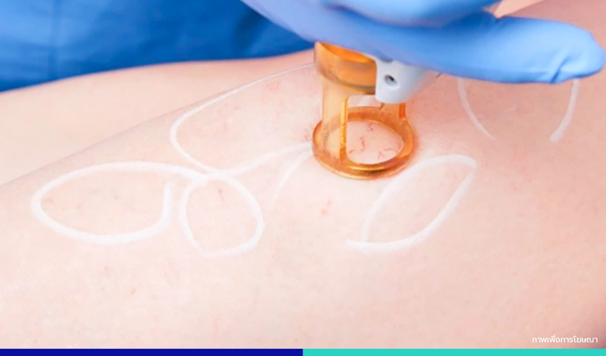 เลเซอร์เส้นเลือดขอด