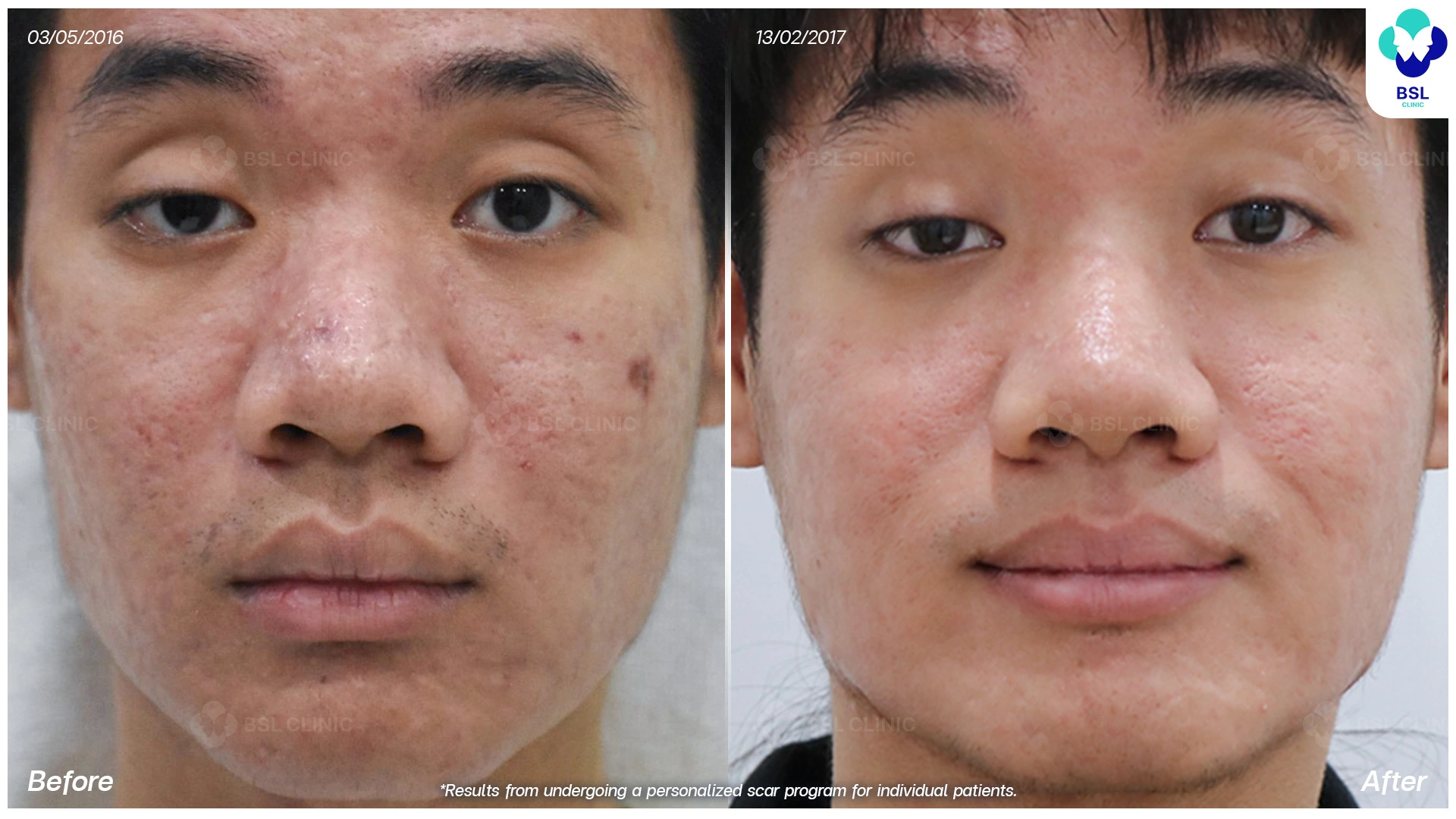 เลเซอร์แผลเป็น