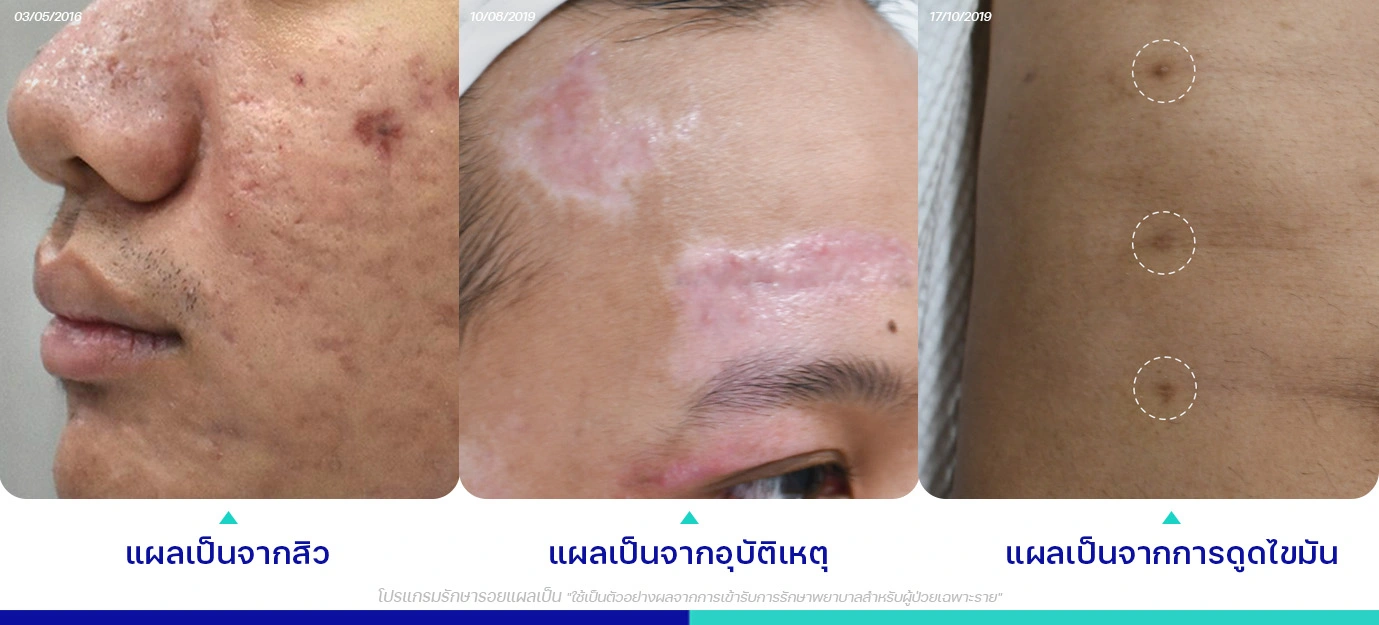 แผลเป็นจากสิว อุบัติเหตุ การผ่าตัด