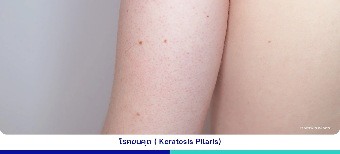 โรคขนคุด(Keratosis-Pilaris)