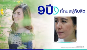 รีวิวรักษาสิว