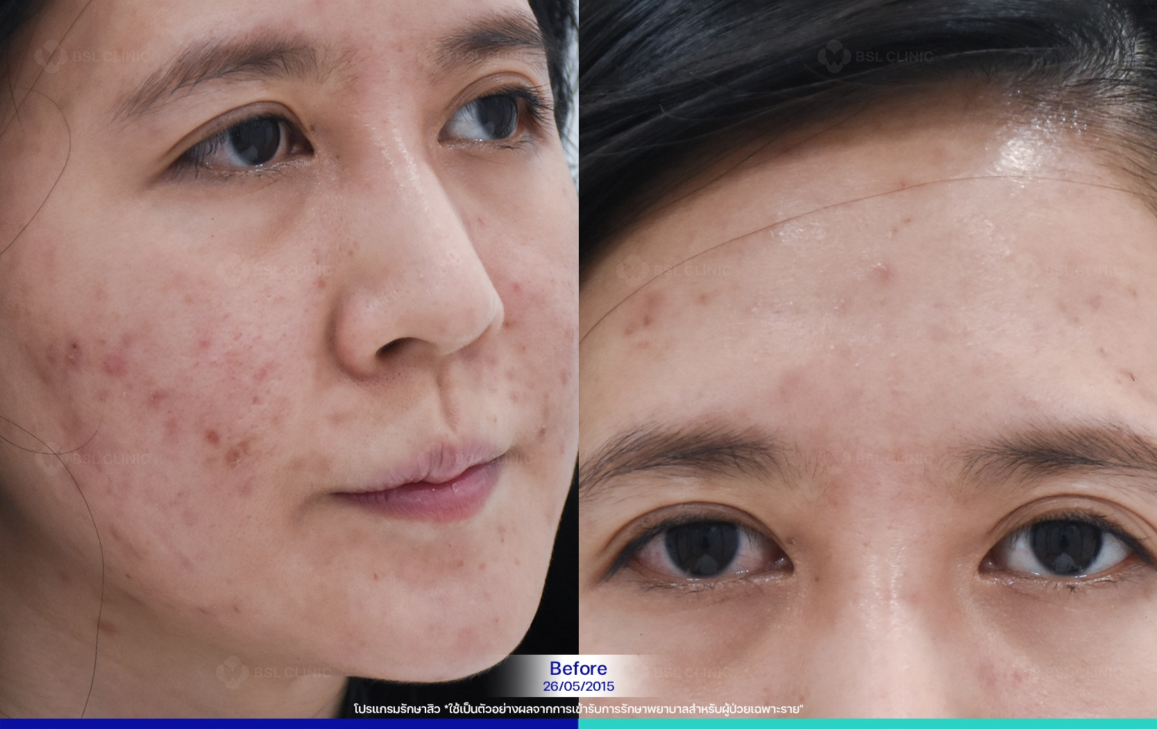 รีวิวสิว BSL