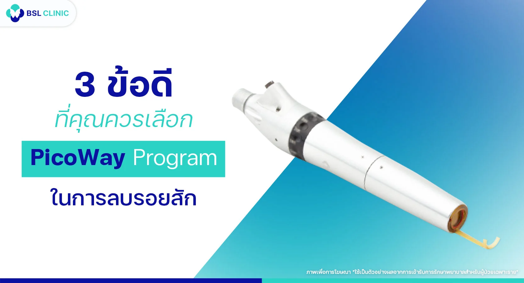 ลบรอยสักด้วย PicoWay Program