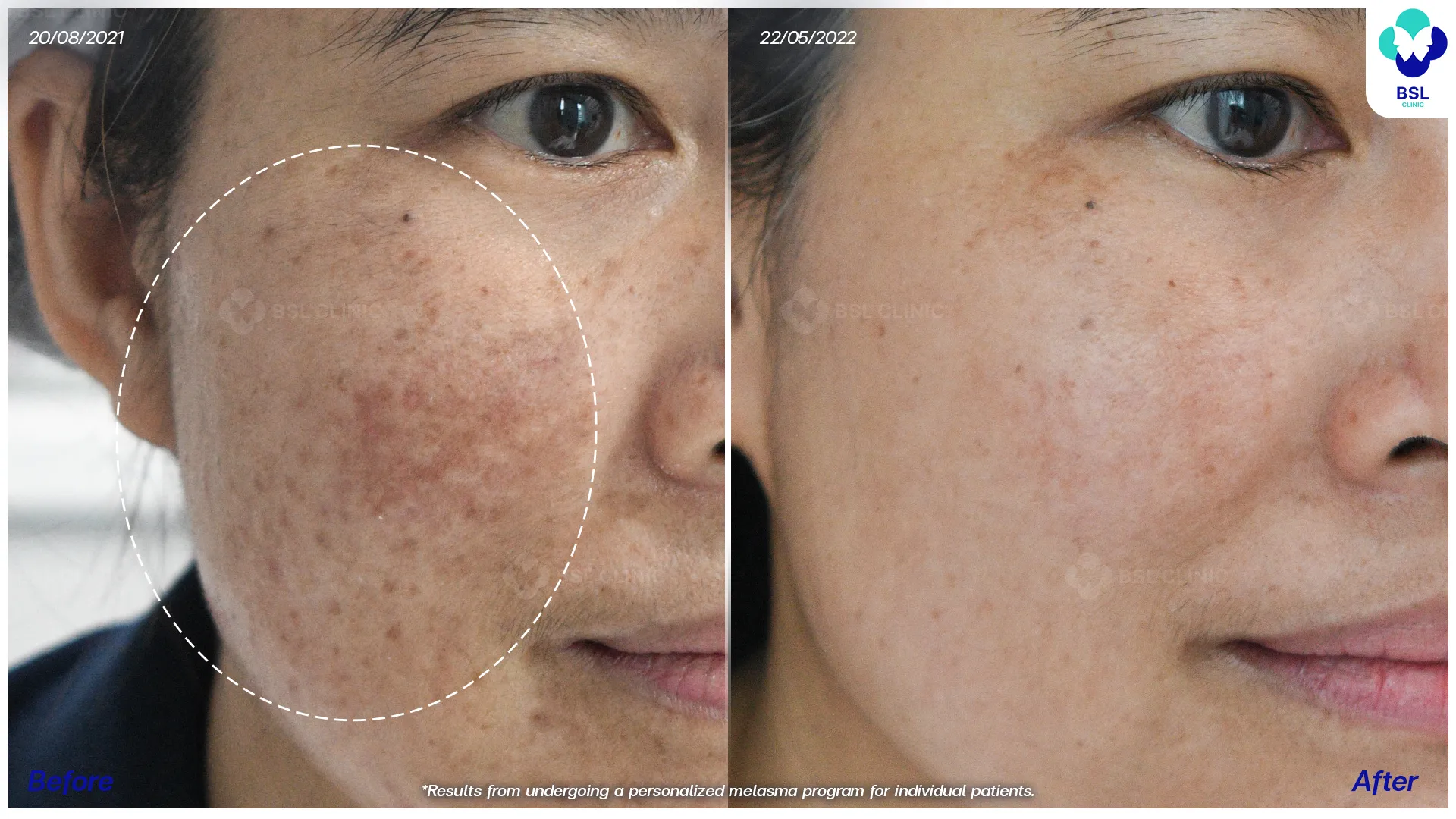 สาเหตุของฝ้า