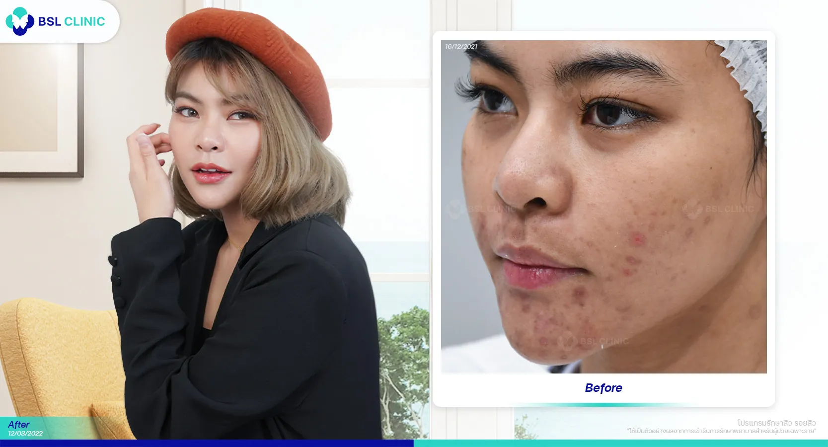 รักษาสิวอุดตัน