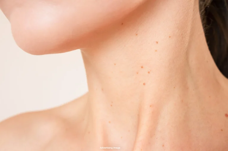 Banner Skin Tags