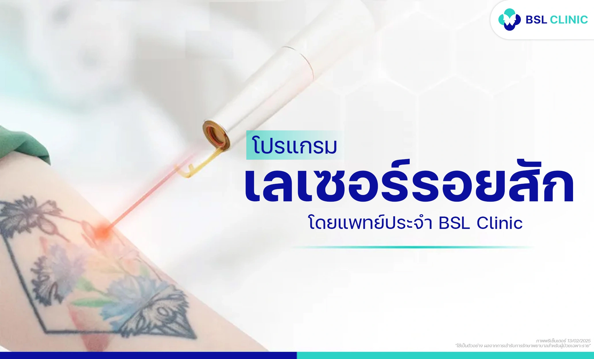 ลบรอยสัก