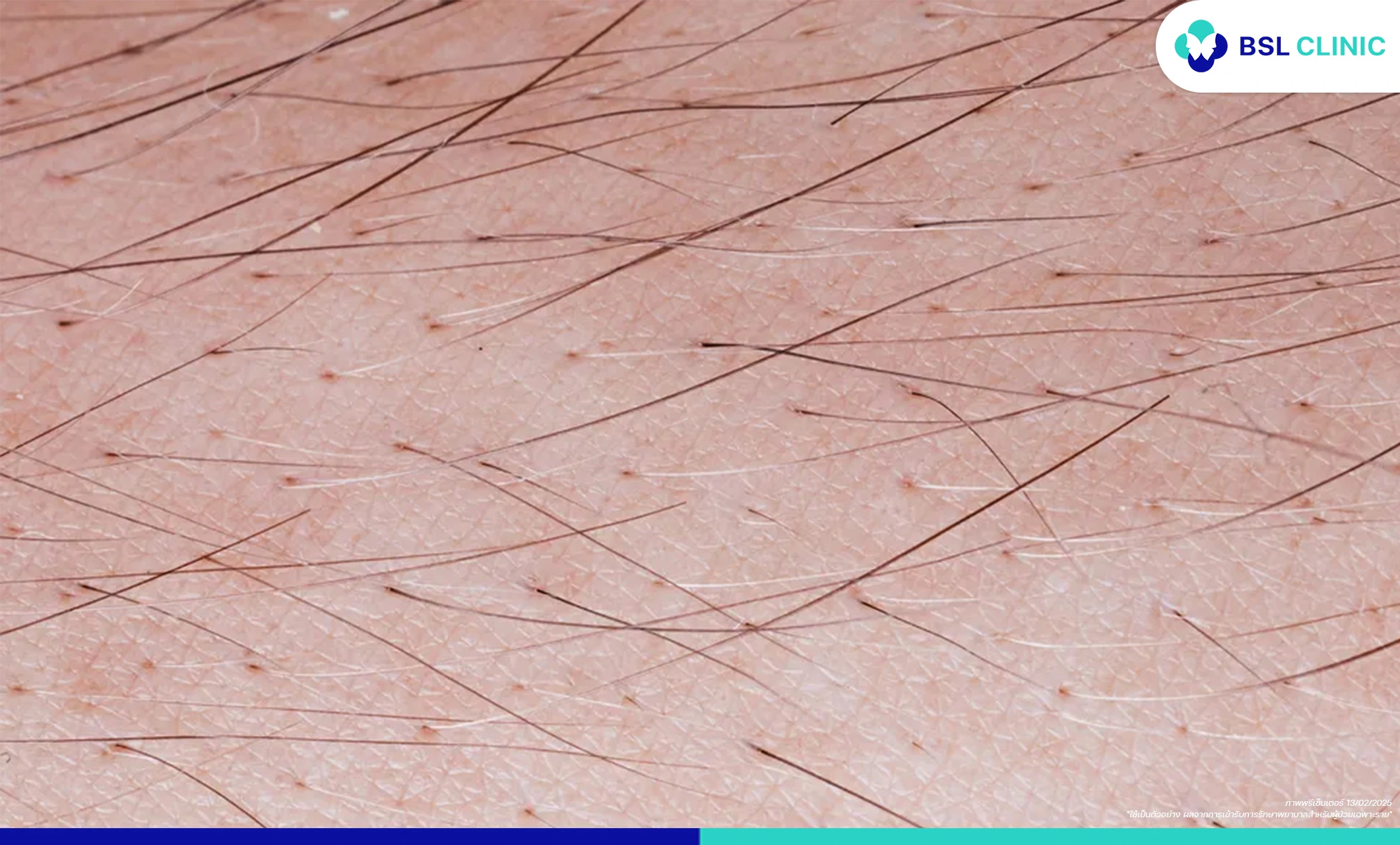 2 ข้อควรรู้ ก่อนเลเซอร์กำจัดขน