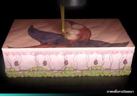 ลบรอยสักด้วย PicoWay Program