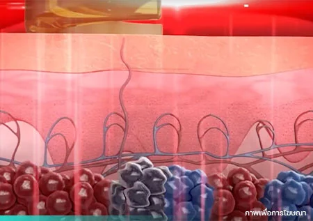 ลบรอยสักด้วย PicoWay Program