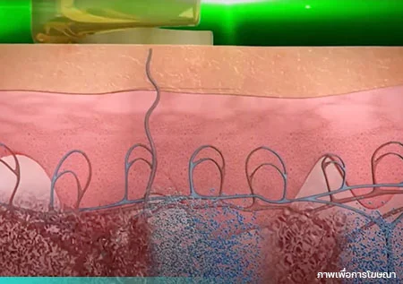 ลบรอยสักด้วย PicoWay Program