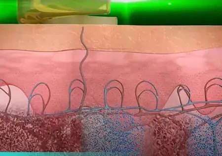 เลเซอร์ลบรอยสัก ม็ดสีแตกตัว