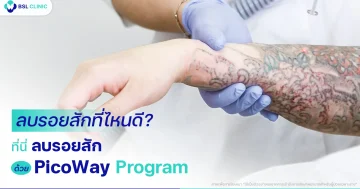 ลบรอยสักที่ไหนดี