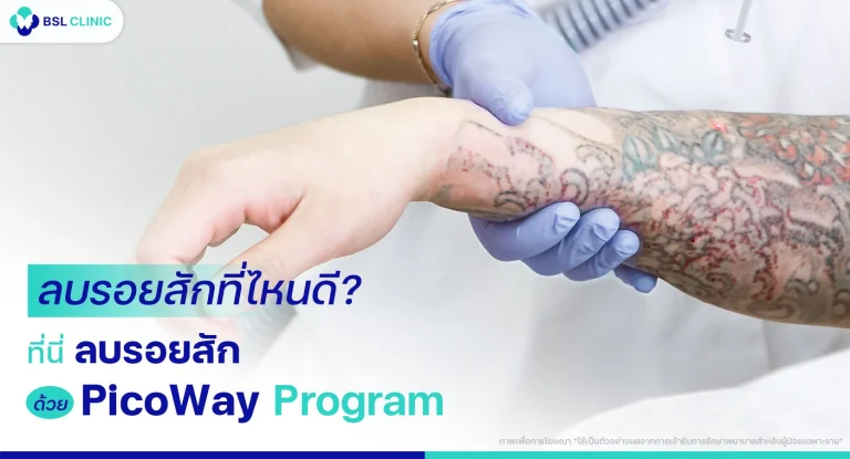 ลบรอยสักที่ไหนดี