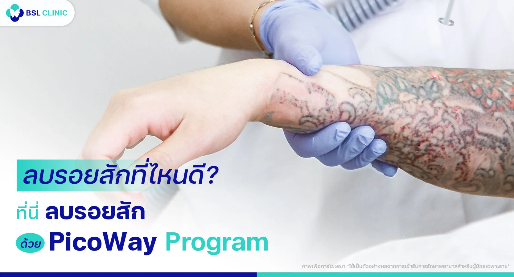 ลบรอยสักที่ไหนดี