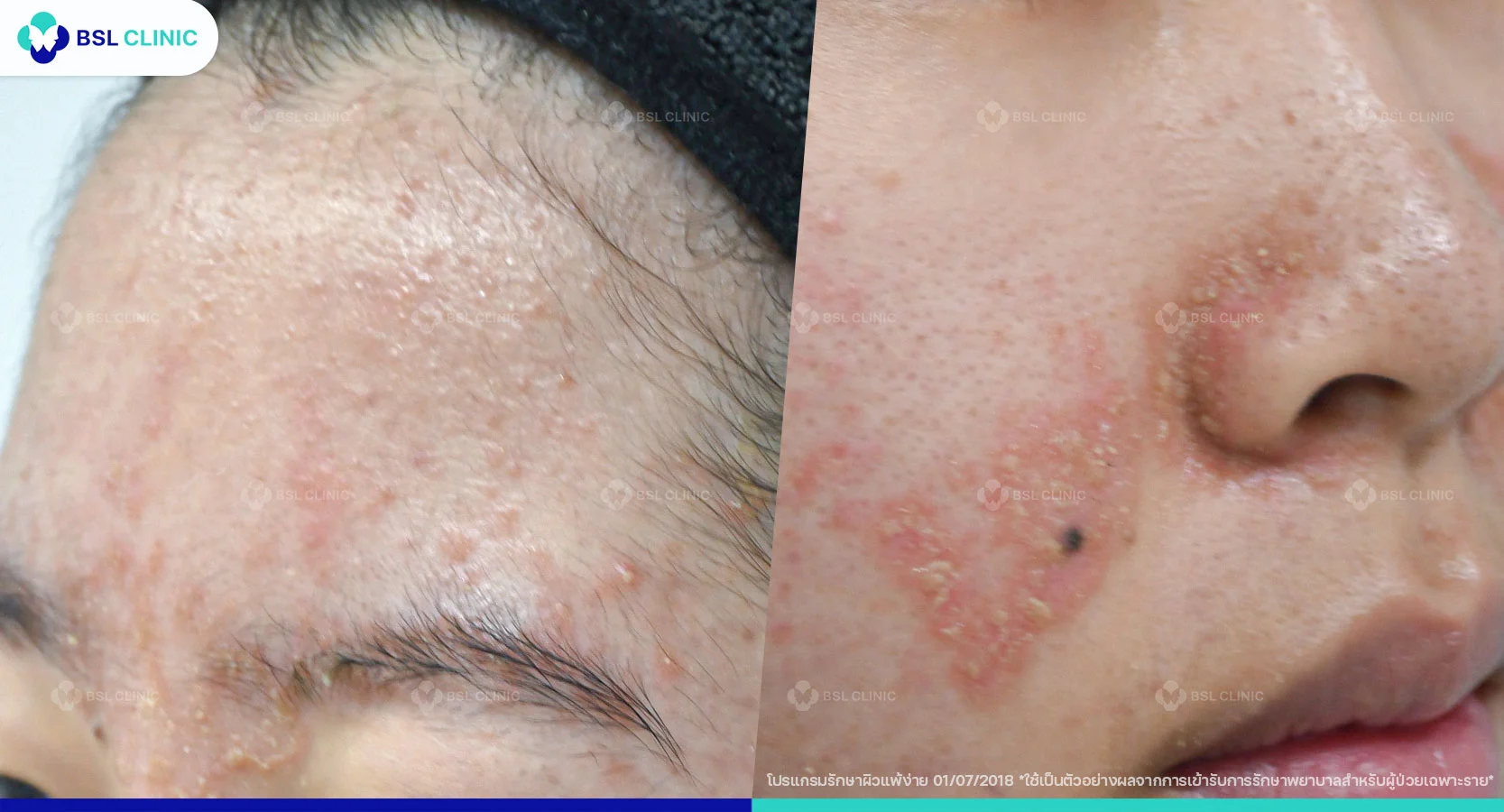 Seborrheic Dermatitis คืออะไร?