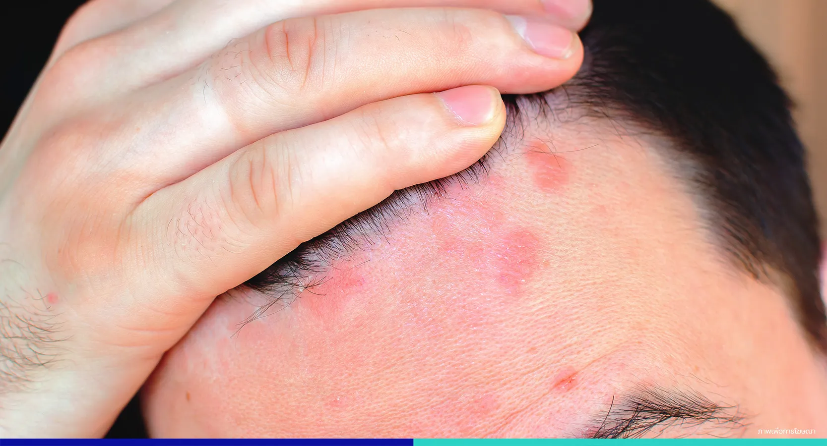 ผื่นคัน