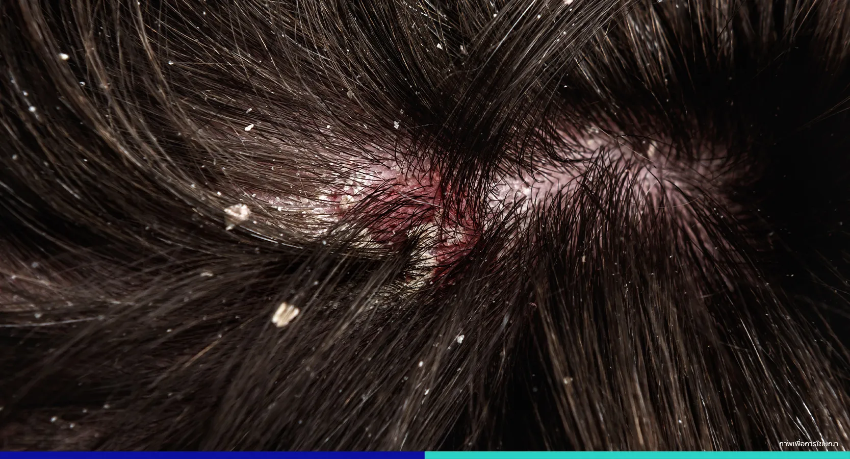 ผื่นคัน