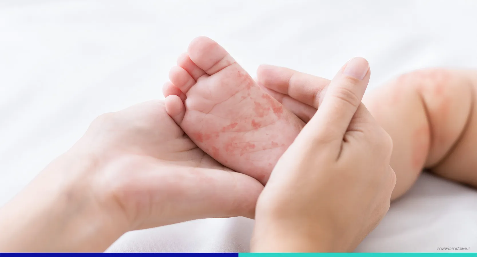อาการแพ้ผิวหนัง