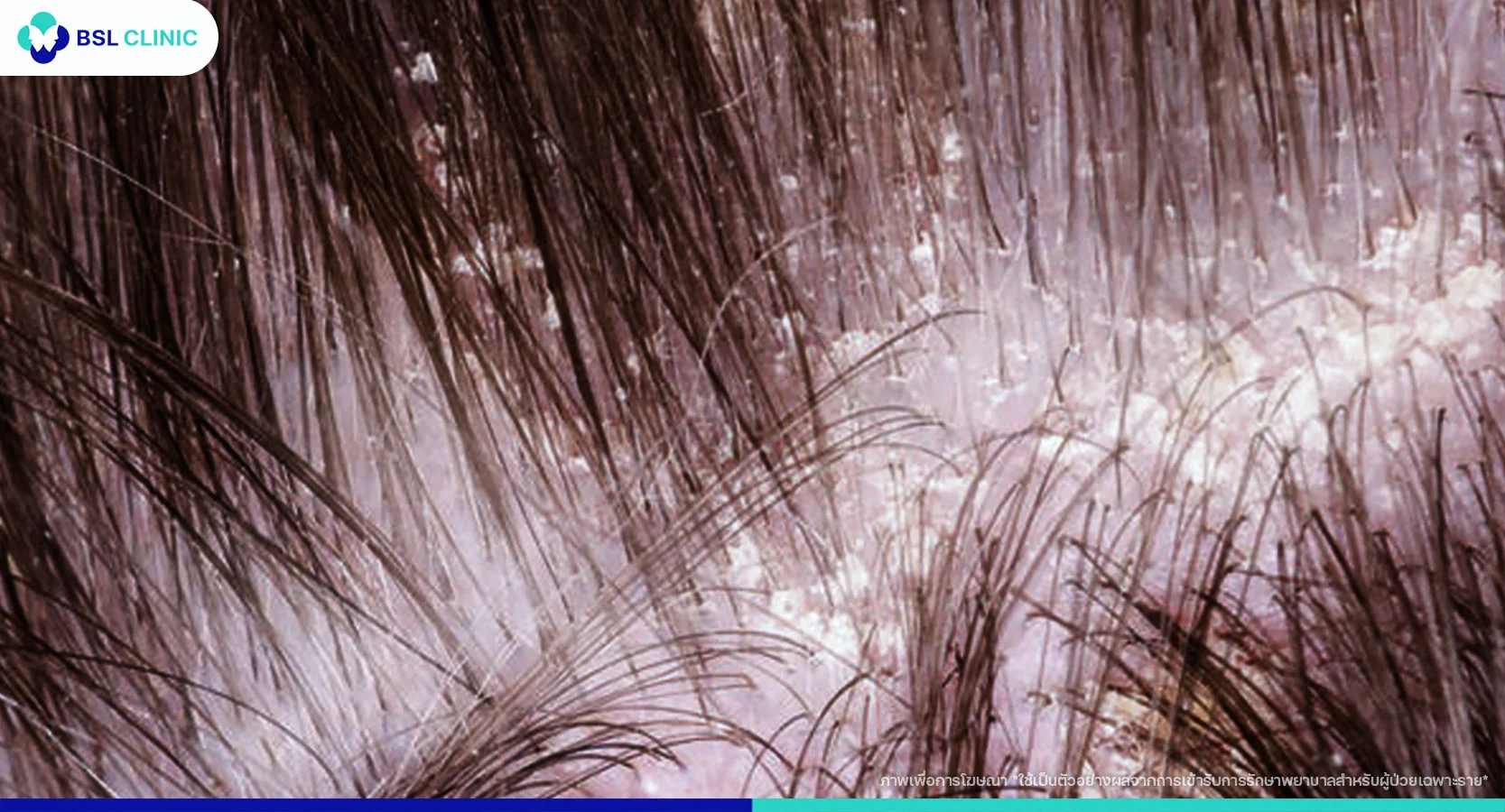 ผื่นเซ็บเดิร์ม