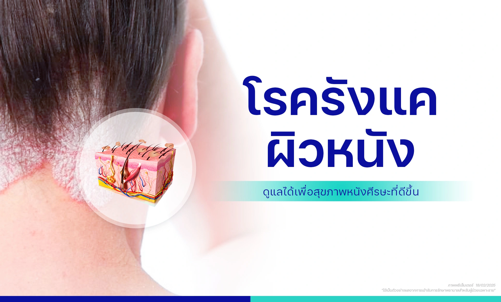 โปรแกรมรักษา รังแค คันหนังศีรษะ