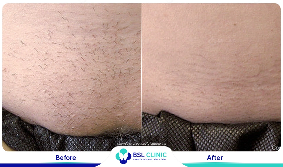 เลเซอร์ขน รักแร้เนียน