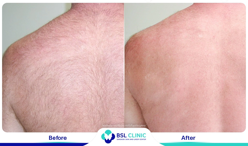 เลเซอร์ขน รักแร้เนียน