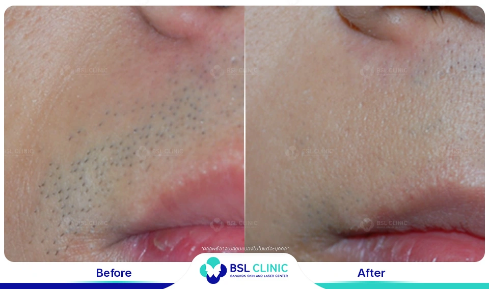 รีวิวเลเซอร์กำจัดขน