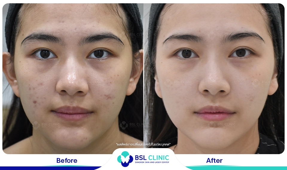 เลเซอร์ผิวกระจ่างใส