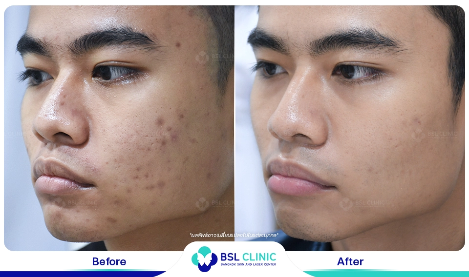 เลเซอร์ผิวกระจ่างใส