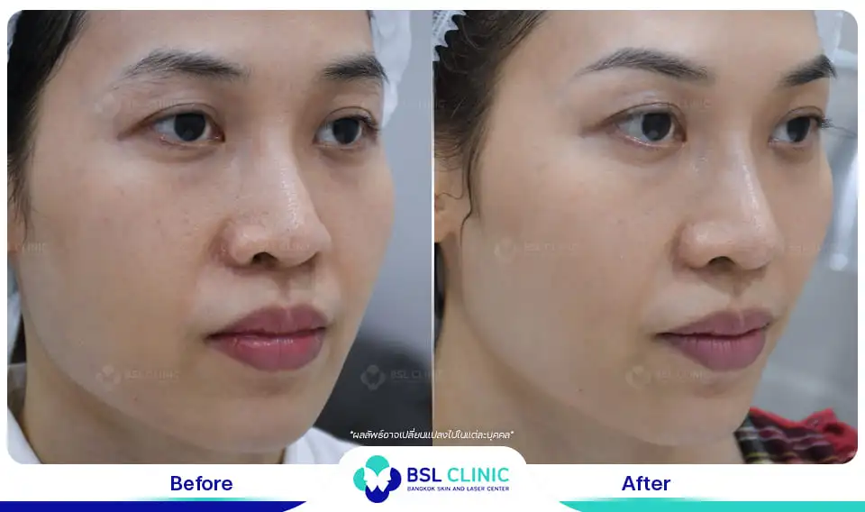 รักษาหน้าหมองคล้ำ