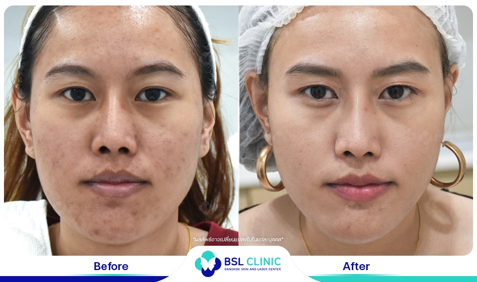 รักษาหน้าหมองคล้ำ